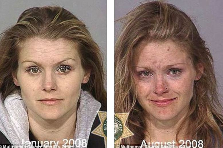 Efectele metamfetaminelor: cum se transforma chipul dependentilor