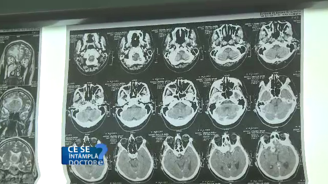 Simptomele care trebuie sa va trimita la medic. Ce poate ascunde o durere de cap insotita de greata