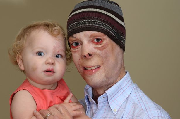 Soldatul britanic care a fost supus la 500 de operatii dupa ce a fost ranit in Afganistan