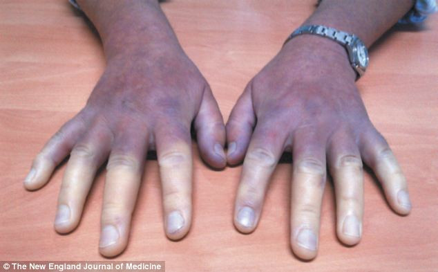 Cum au ajuns mainile acestei femei sa arate asa. Boala grava de care sufera