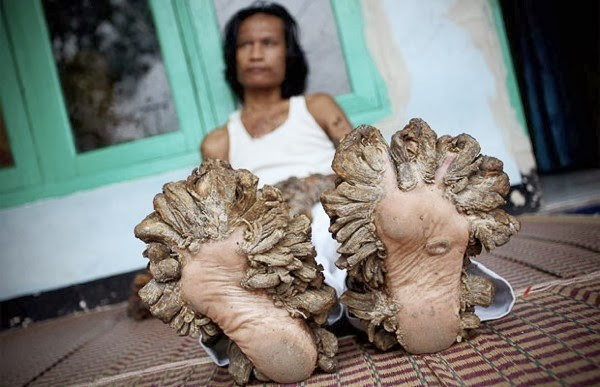 Povestea trista a omului copac. Calvarul la care este condamnat din cauza unei boli incurabile