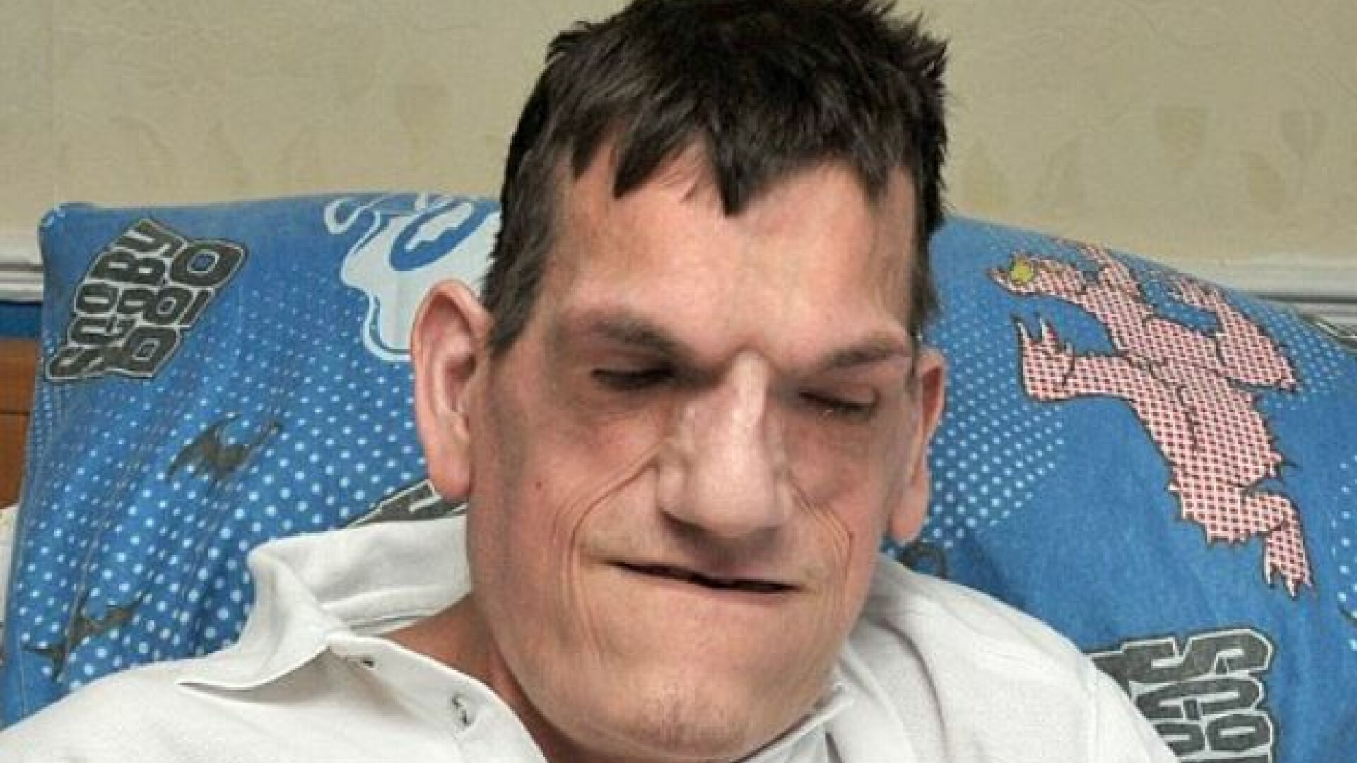 "Omul elefant." Un tanar englez a suferit 74 de operatii si nu a mai iesit din casa in ultimii ani