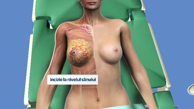 Premiera in Romania. Cum au reconstruit medicii sanii unei paciente, dupa o mastectomie la cerere
