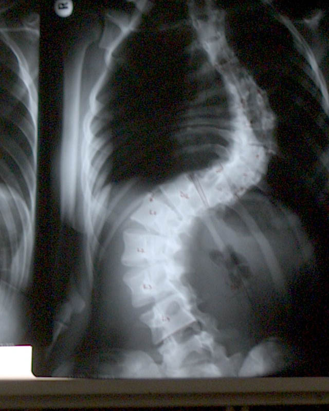 Cum a ajuns o tanara de 18 ani cu scolioza sa ajunga model in Marea Britanie