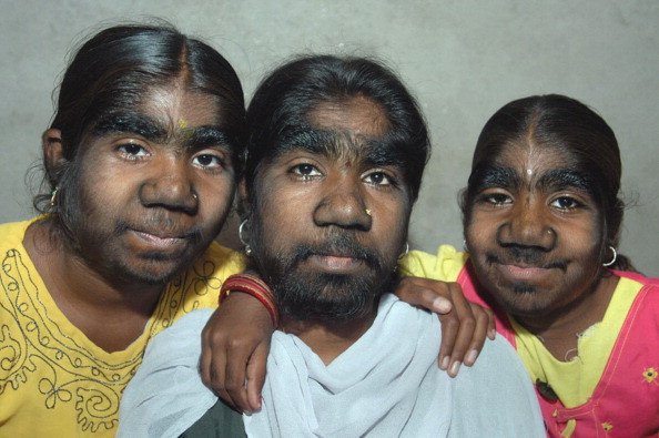 Transformarea spectaculoasa prin care a trecut o familie care suferea de sindromul "omului-lup"