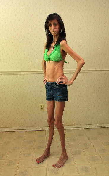 Lizzie Velasquez