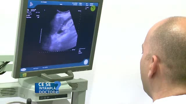 Intoxicatia cu alcool, principalul motiv al aparitiei cancerului hepatic. Recomandarile medicilor