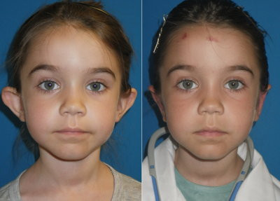 Fetita de 6 ani dusa la chirurgul estetician dupa ce a venit plangand acasa. Cum arata dupa operatie