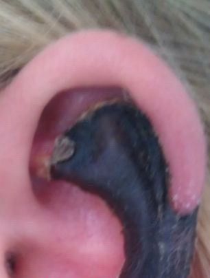 Urechea unei femei din Olanda s-a innegrit si s-a dizolvat, dupa ce a fost muscata de paianjen. FOTO