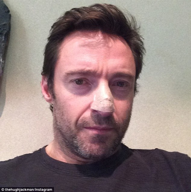 Hugh Jackman a fost operat a doua oara de carcinom bazocelular la nivelul nasului