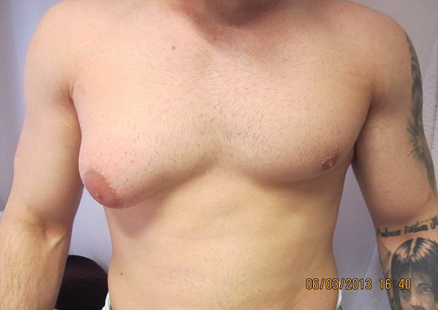 "Am vrut sa mi-l tai singur". Un barbat s-a trezit, peste noapte, cu un san marimea B. FOTO