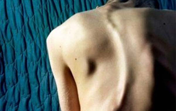 Articolul tau: Despre scolioza si suflet