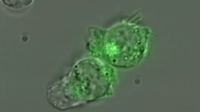 Premiera istorica. O femeie de 49 de ani a fost vindecata de cancer cu ajutorul virusului rujeolei