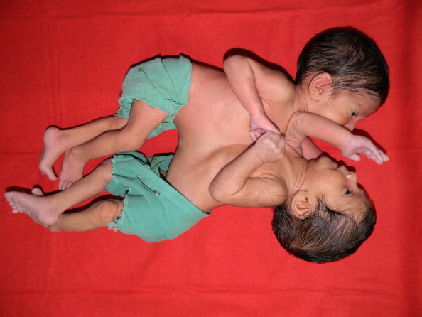 Medicii se lupta sa salveze doua fetite siameze abandonate intr-un orfelinat din China