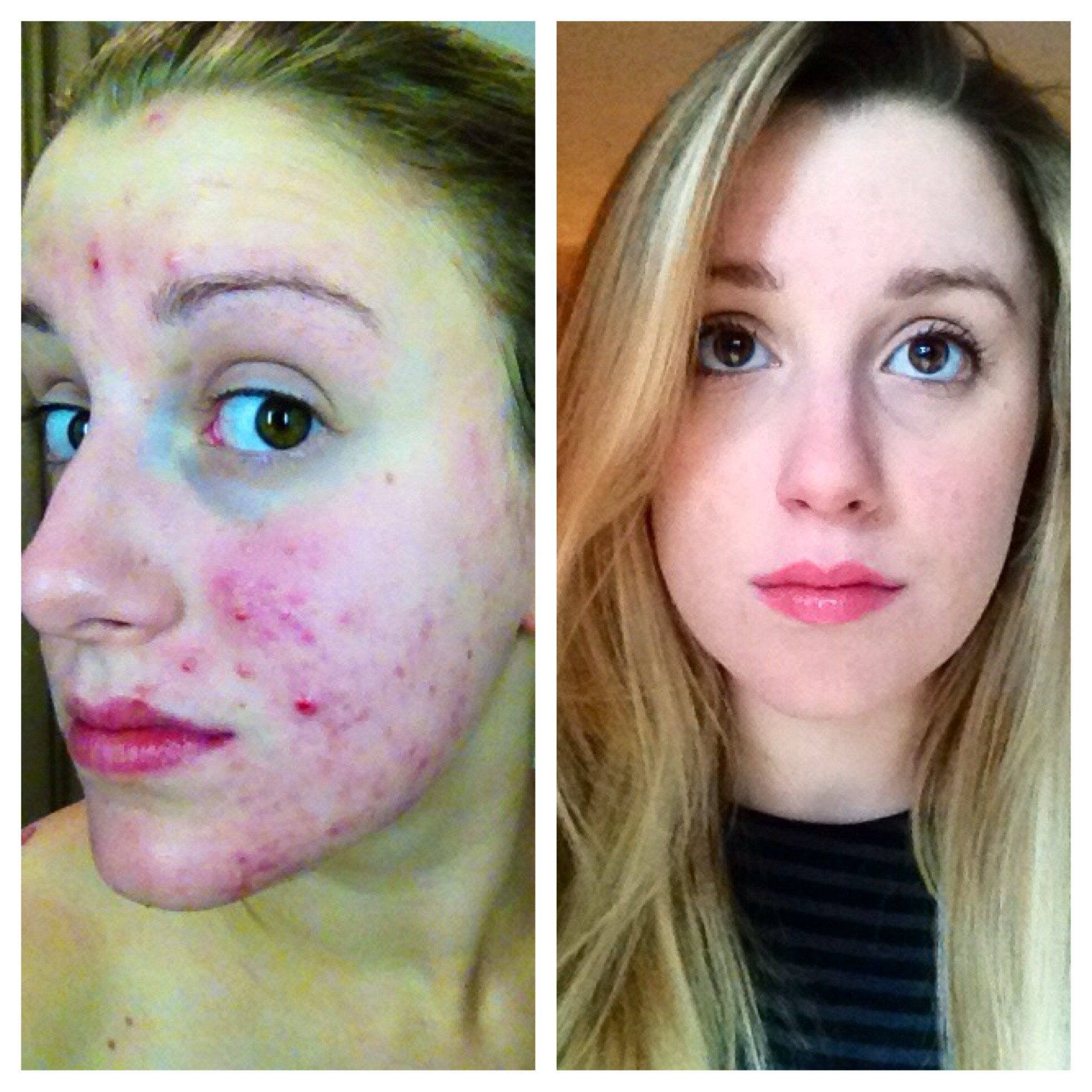 "Dupa 7 luni de lupta am obraji fini ca de bebelus". Lupta acestei tinere cu acneea