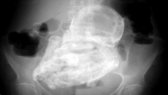 Doctorii au gasit un fetus de 40 de ani pietrificat in pantecele unei femei de 82 de ani. VIDEO