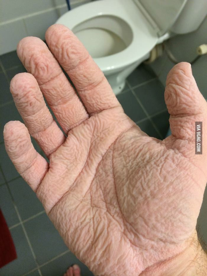 A adormit in cabina de dus. Cum arata mana barbatului dupa ce a stat timp de trei ore in apa