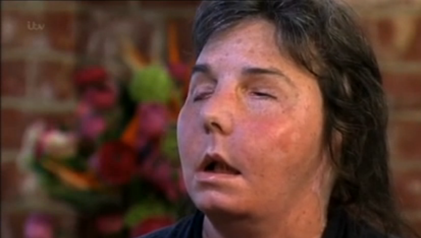 Povestea femeii atacate cu detergent industrial de sotul ei. A avut nevoie de un transplant de fata