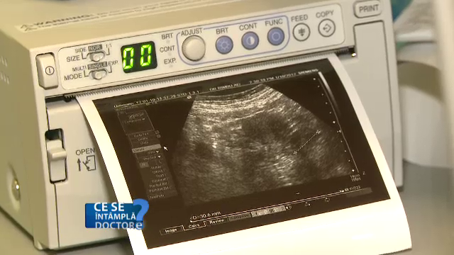 Nu luati antiinflamatoare daca aveti tulburari urinare sau disconfort. Recomandarile urologilor