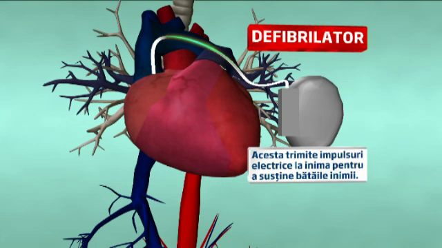 Romania vrea sa opreasca moartea subita. In ce conditii primesti un implant de defibrilator cardiac pe bani de la stat