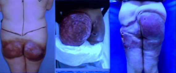 Riscurile unei operatii estetice ilegale. Cum arata dupa cativa ani un posterior care azi atrage toate privirile