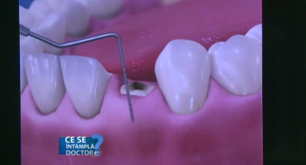 Pierderea dintilor nu este cauzata doar de carii. Ce trebuie sa faci dupa o extractie dentara