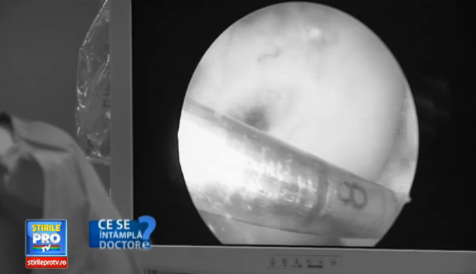 Persoanele cu probleme de mobilitate la nivelul genunchiului pot beneficia de proteze personalizate