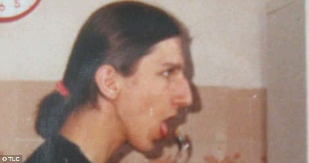 "Operatiile estetice m-au transformat in Omul Elefant". Cum arata nasul acestui barbat acum