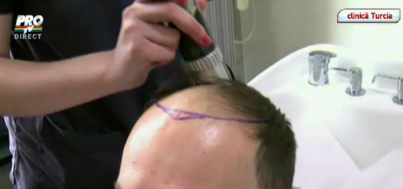 Inca un barbat din showbiz-ul romanesc si-a facut implant de par, pe reteta Traistariu
