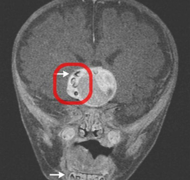 Cazul unic in lume care a luat prin surprindere lumea medicala. Dinte descoperit in tumoarea de pe creierul unui copil