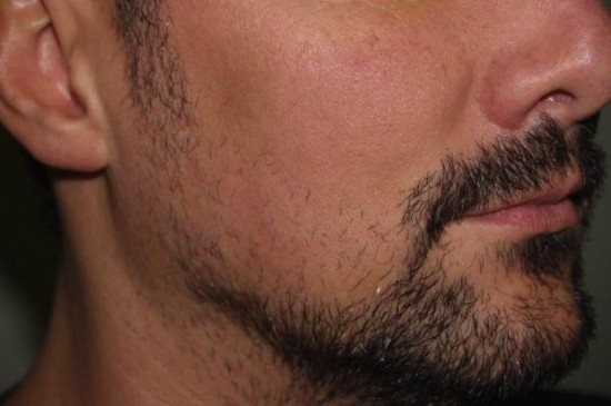 Noua moda printre tineri. Barbatii apeleaza la implanturi de par facial pentru a avea aspectul dorit