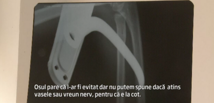 Accident infricosator la un centru de minori din Arad. Un copil de 12 ani a ajuns la spital cu o clanta infipta in brat