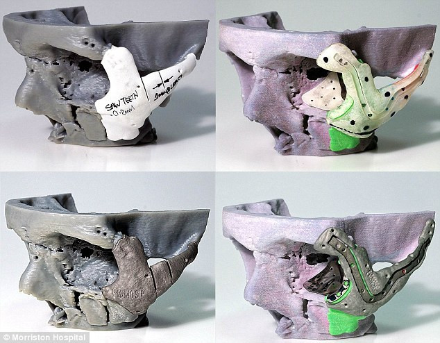 Operatie in premiera. Craniu imprimat 3D, realizat pentru victima unui acident de motocicleta