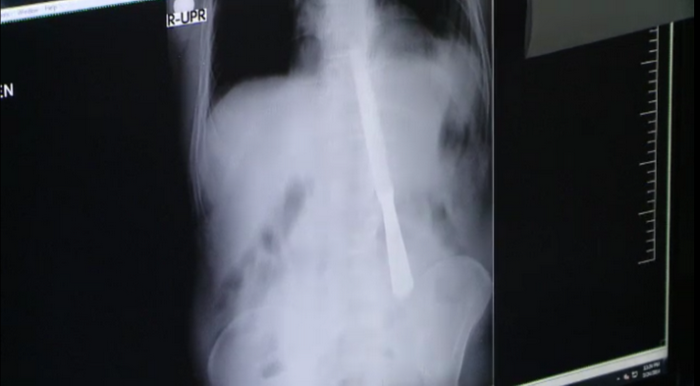 Pacientul cu surprize pentru medicii din Iasi. Ce au gasit in stomacul unui barbat dupa ce i-au facut o radiografie