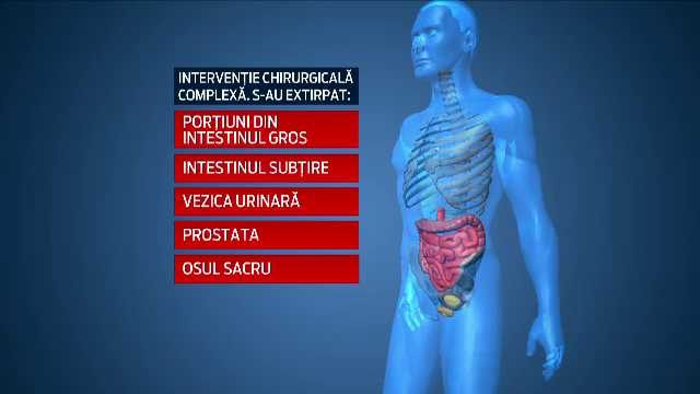 Operatie extrema, incheiata cu succes, in Romania. 9 chirurgi au operat un tanar ale carui organe erau invadate de cancer
