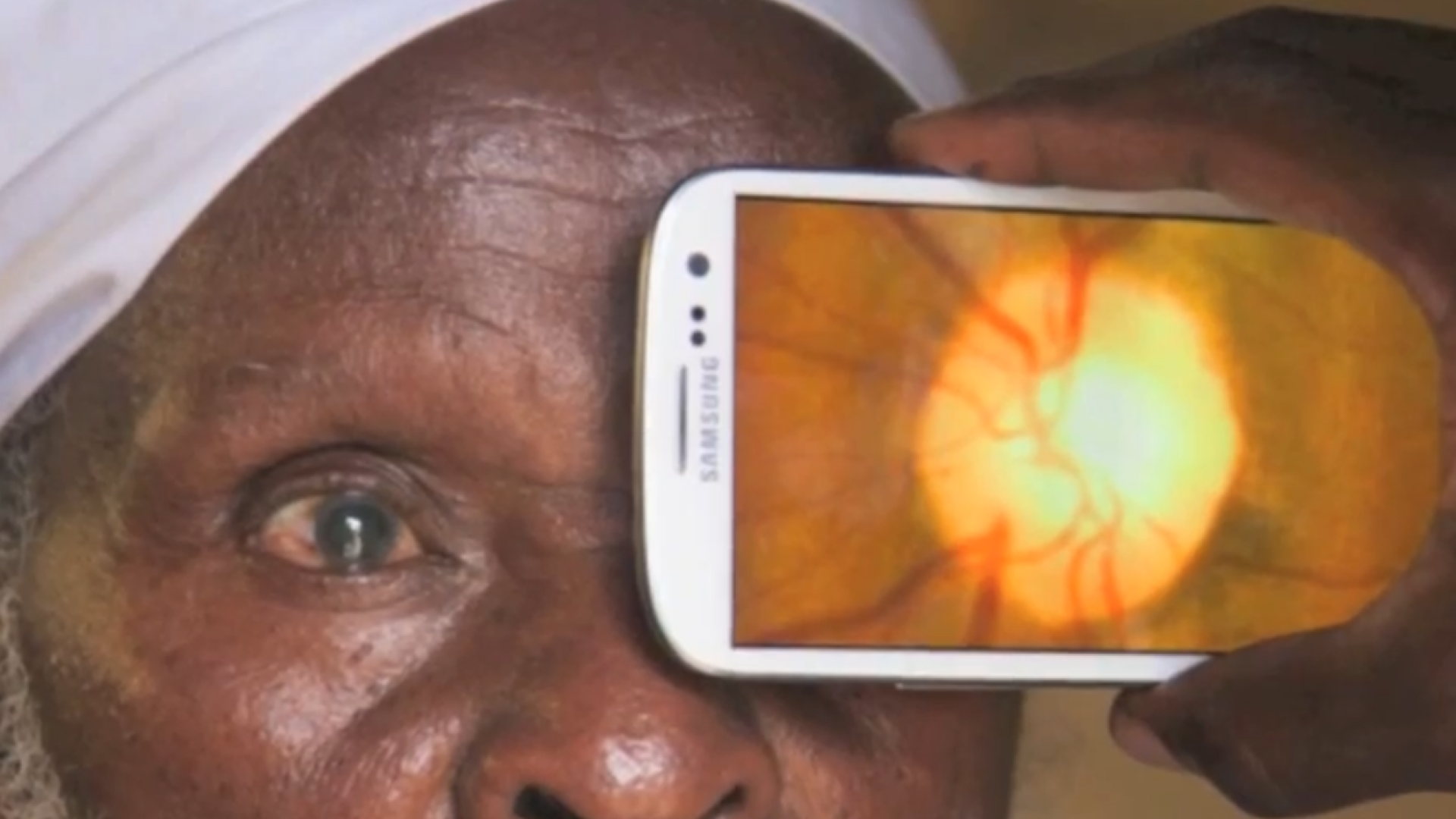 Milioane de oameni ar putea fi salvati de la orbire. Cum functioneaza aplicatia care tine locul unui oftalmolog