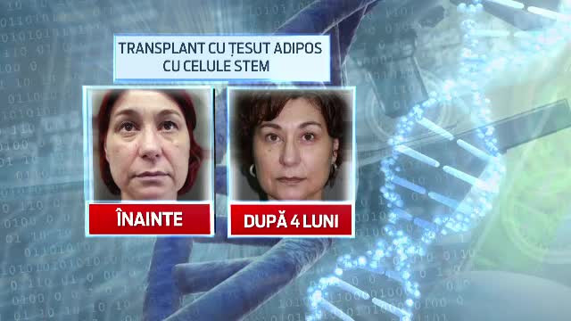 Grasimea inestetica de pe abdomen, miracol pentru chip. Efectele benefice pe care le au celulele stem din aceasta zona