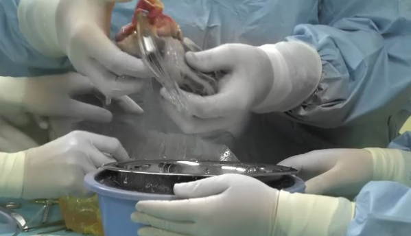 Salvare miraculoasa la Targu Mures. Un barbat de 59 de ani a primit o inima noua