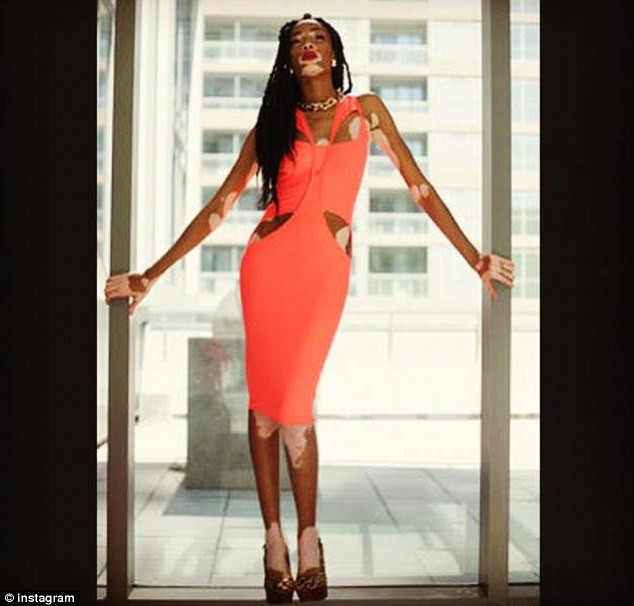 In scoala era poreclita "zebra" si "vaca". Destinul surprinzator al tinerei cu boala pe care o avea si Michael Jackson