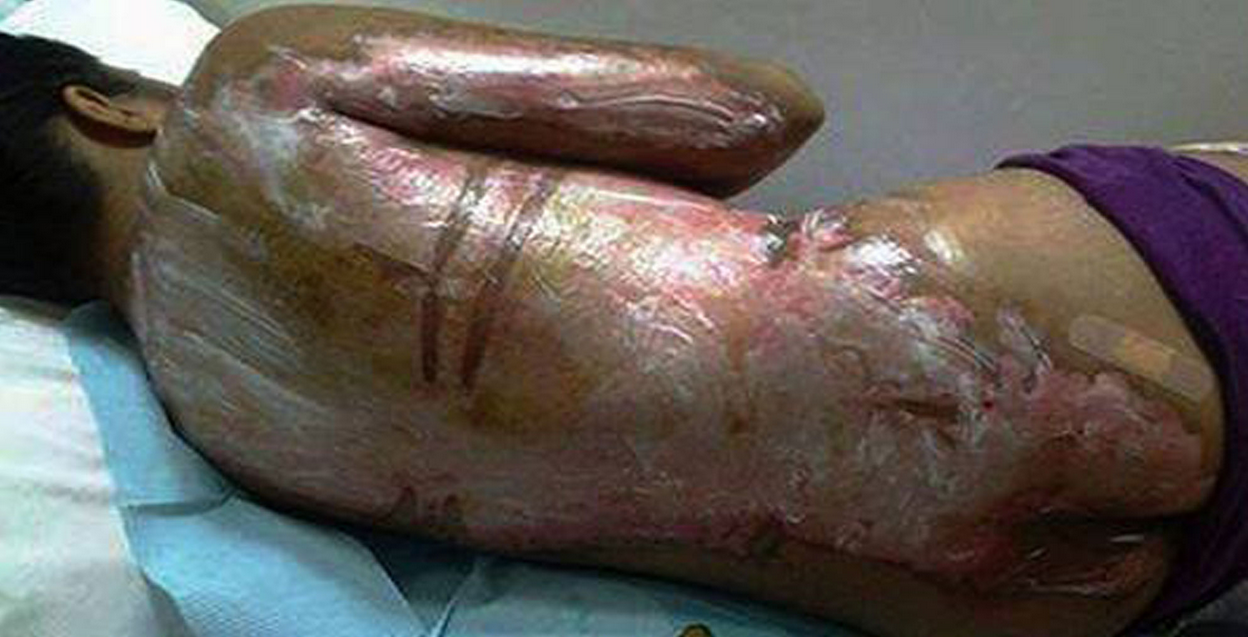 Ranile suferite de menajera filipineza