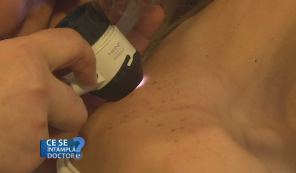 Luna mai, perfecta pentru un control la dermatolog. De ce verificarea alunitelor e obligatorie inainte de concediu