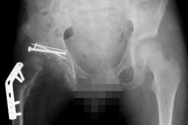 Un artist norvegian si-a mancat propriul şold, dupa medicii i l-au inlocuit cu o proteza. Cum a descris experienta