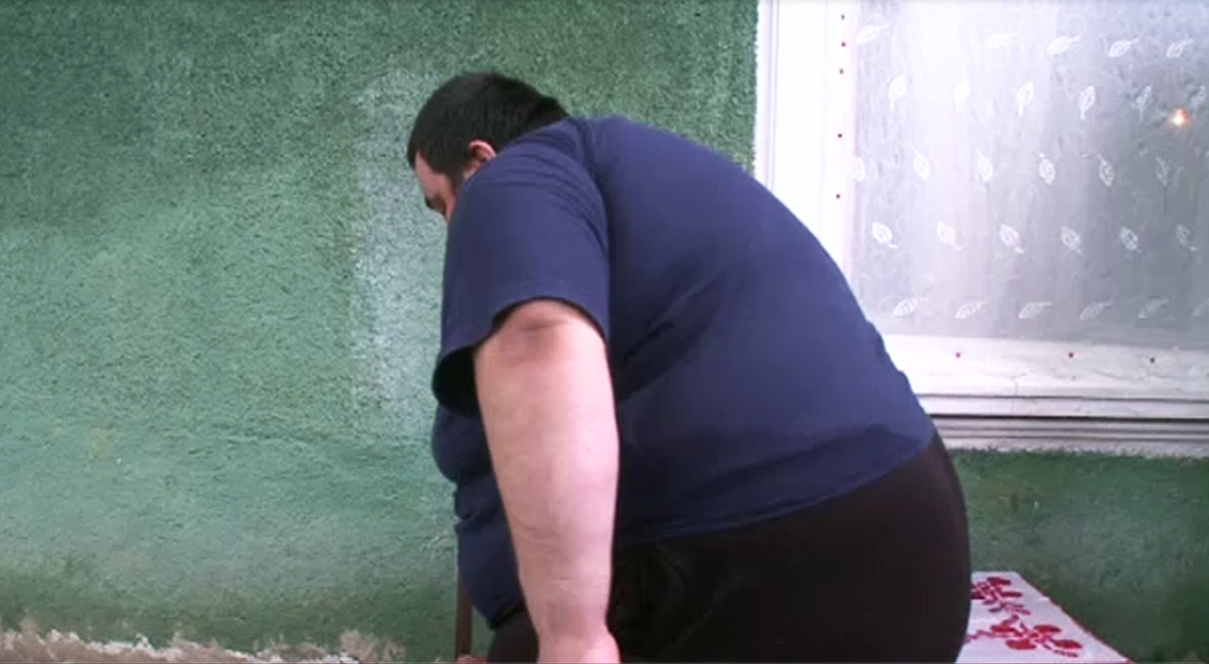 Ce a patit un tanar din Romania dupa ce a slabit 160 de kilograme. Are un metru patrat de piele moarta