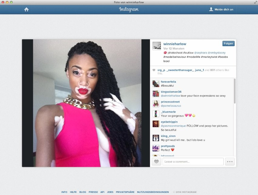 Secretul dureros al acestei tinere: In scoala era poreclita "zebra" si "vaca", acum a devenit un model de urmat