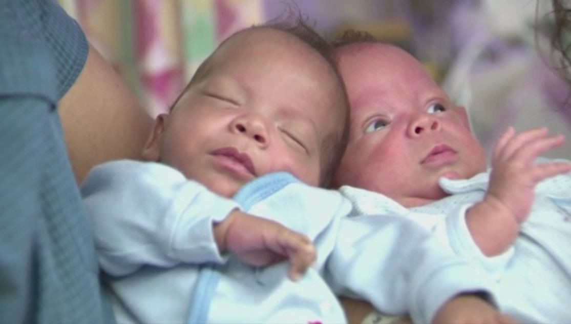 Se intampla o data la 100.000 de nasteri. Sunt gemeni, dar au venit pe lume la 24 de zile distanta