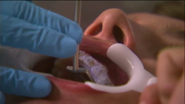 Adio, freze si injectii. A aparut o noua tehnologie de tratare a dintilor prin impulsuri electrice, fara durere