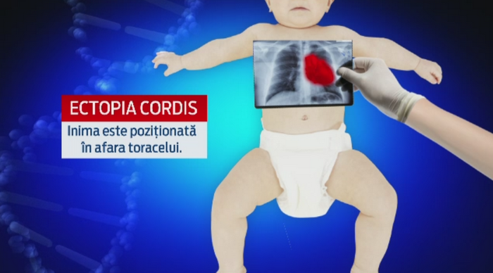 Abandonat si cu o malformatie grava, un bebelus roman va fi operat in Italia. Povestea celui alintat "Richard Inima de Leu"