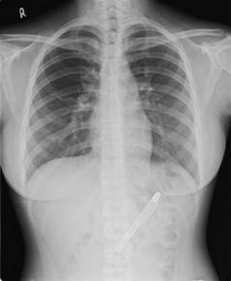 Medicii au scos un stilou din stomacul unei femei care suferea de dureri cumplite. Cum explica tanara incidentul