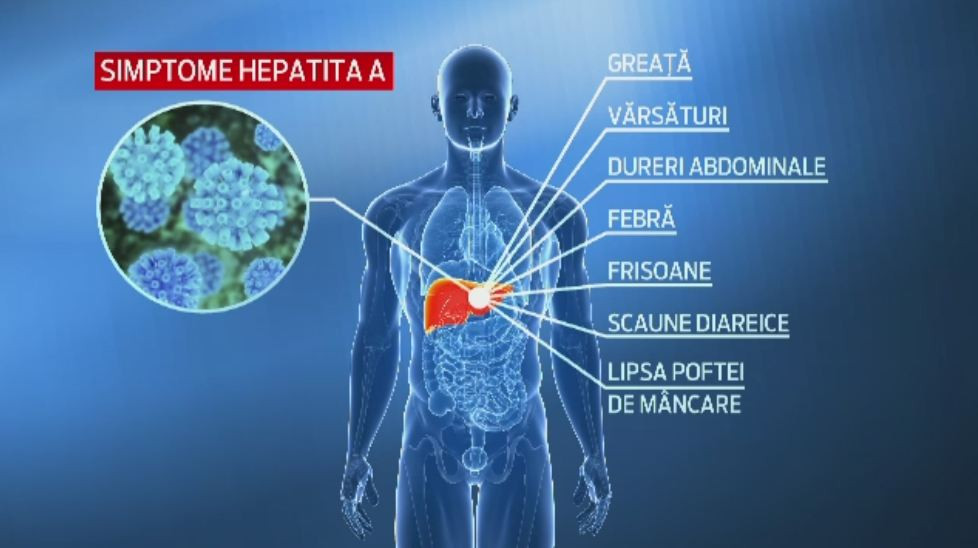A venit vara si va spunem cum sa va feriti de hepatita A. Ce ne recomanda medicii