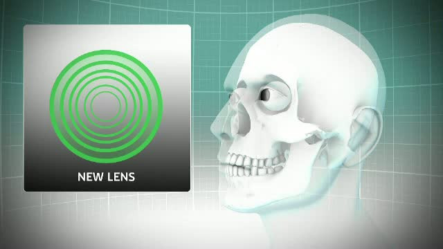 Ochelarii ar putea deveni o amintire. Operatia de 15 minute care corecteaza problemele de vedere